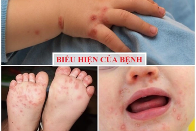 TRƯỜNG MẦM NON TRUNG THÀNH TĂNG CƯỜNG CÔNG TÁC PHÒNG, CHỐNG BỆNH CHÂN TAY MIỆNG CHO TRẺ