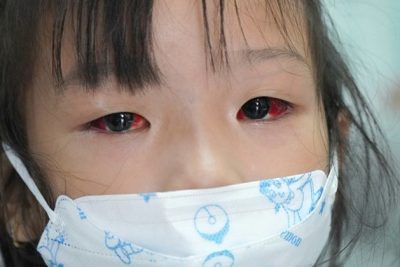 TRƯỜNG MẦM NON TRUNG THÀNH TUYÊN TRUYỀN VỀ BỆNH ĐAU MẮT ĐỎ